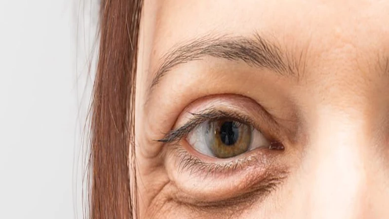 انتفاخ الجفون وحكة الجلد.. علامات تحذيرية قد تكون مرتبطة بالكلى