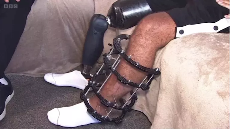 نجم الدوري الإنجليزي السابق يفقد ساقه بسبب امرأة..ما القصة؟