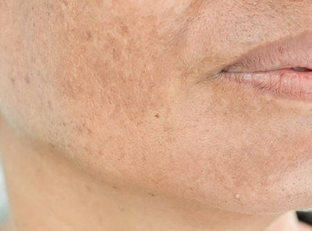 دليل علاج تصبغات الوجه: خطوات للحصول على بشرة متوهجة وموحدة اللون