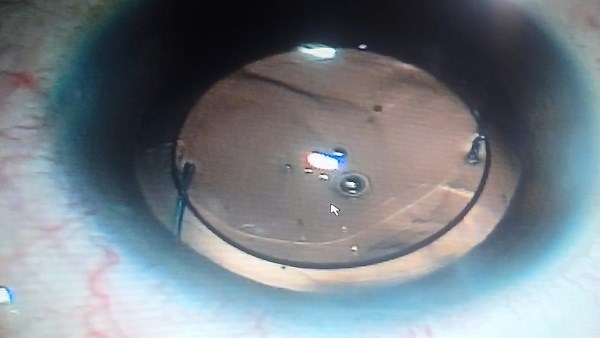 تدخل جراحي دقيق.. إنقاذ عين مريضة بمستشفى رمد المنصورة