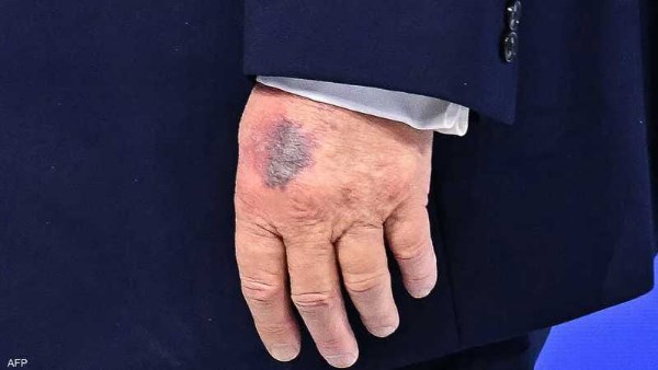 اصطدم بطاولة في دافوس.. سبب ظهور كدمة على يد ترامب