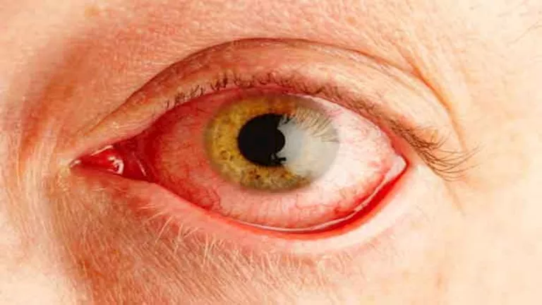 نصائح لمرضى الرمد في العاصفة الترابية