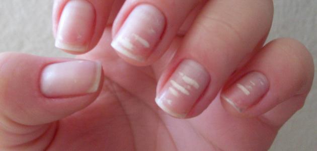 انتبهي لأظافرك.. علامة صامتة قد تكشف خطرًا صحيًا لا ترينه