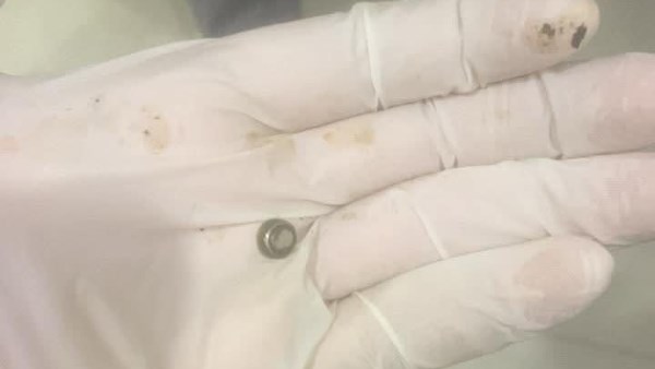 استخراج شوكة سمكة وحجر ساعة من ربة منزل وأنف طفل بمستشفى قنا العام