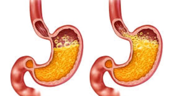 التهاب المعدة وارتجاع المريء.. أعراضه وكيف يمكنك التخلص منه
